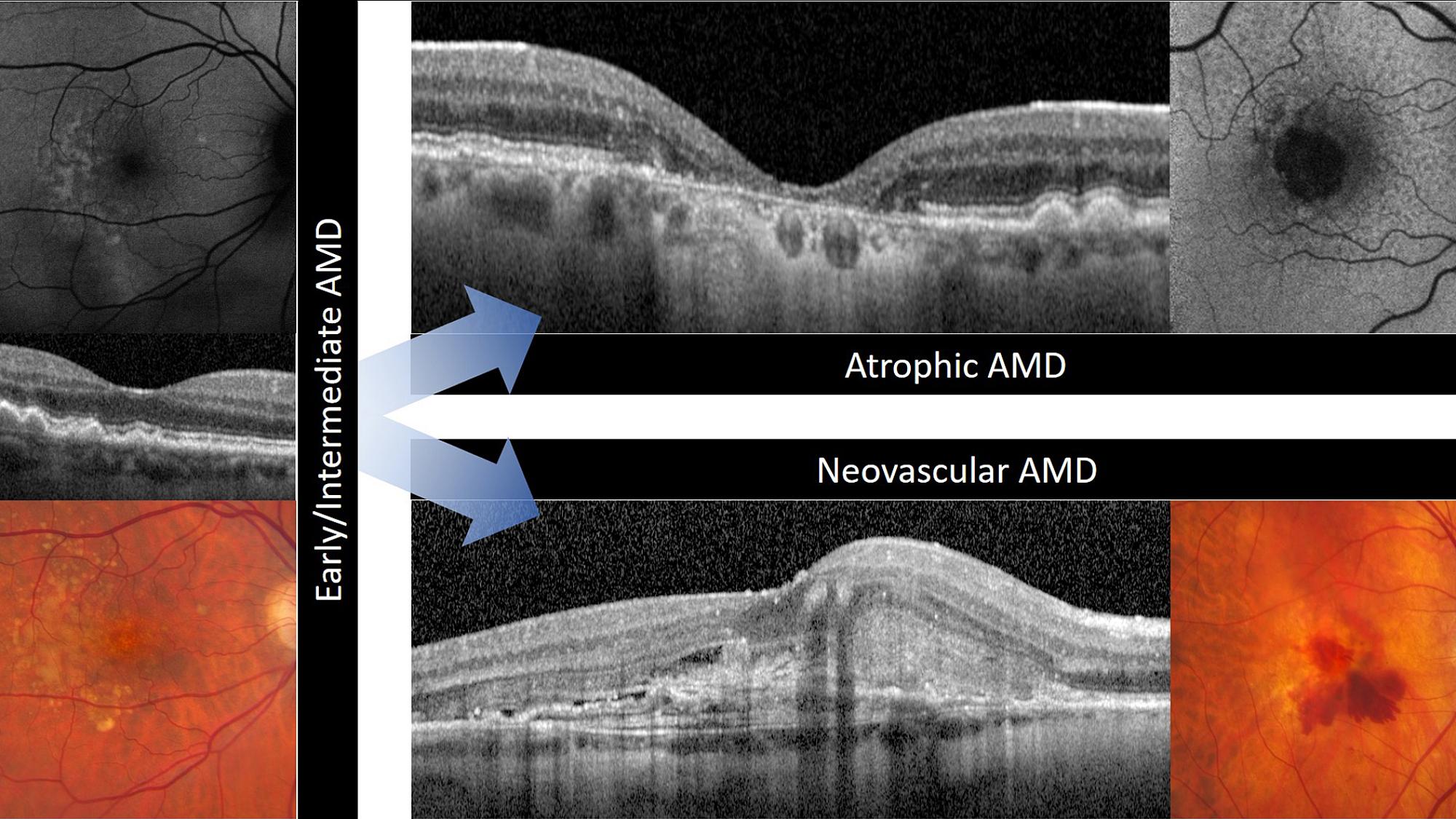 AMD disease progression research imaging.