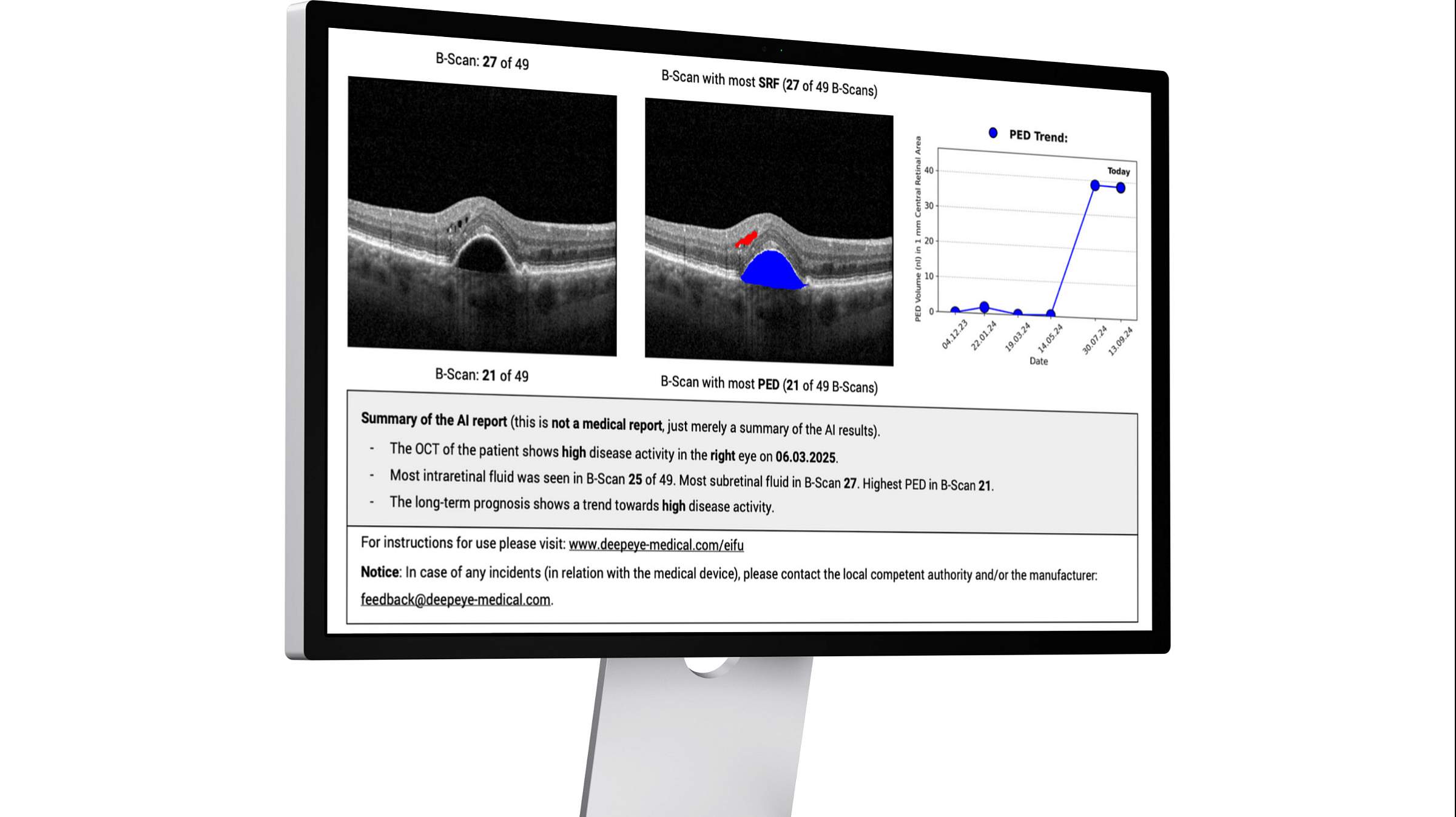 A sample of the deepeye® TPS dashboard for ophthalmology therapy management.